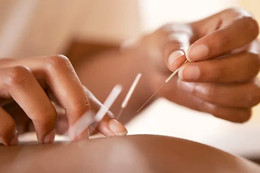 acupuncture